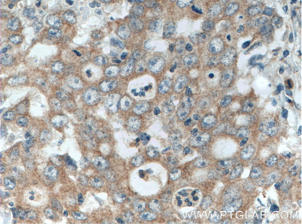 Immunohistochemistry (IHC) staining of human stomach cancer tissue using EDEM3 Polyclonal antibody (27310-1-AP)