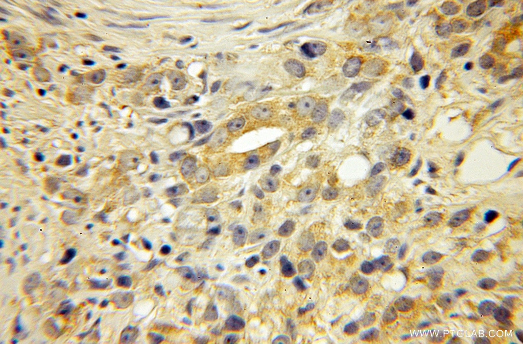 Immunohistochemistry (IHC) staining of human prostate cancer tissue using EDF1 Polyclonal antibody (12419-1-AP)