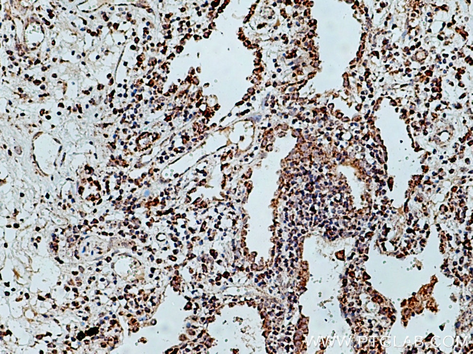 IHC staining of human lung cancer using 12580-1-AP