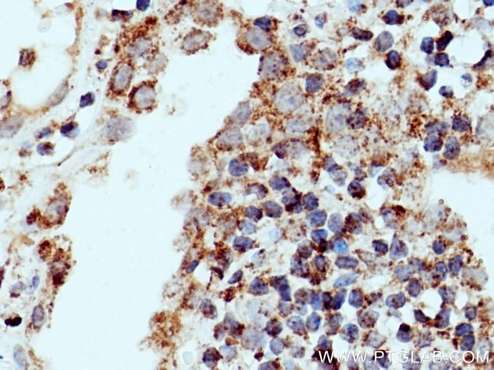 Immunohistochemistry (IHC) staining of human lung cancer tissue using EDIL3 Polyclonal antibody (12580-1-AP)