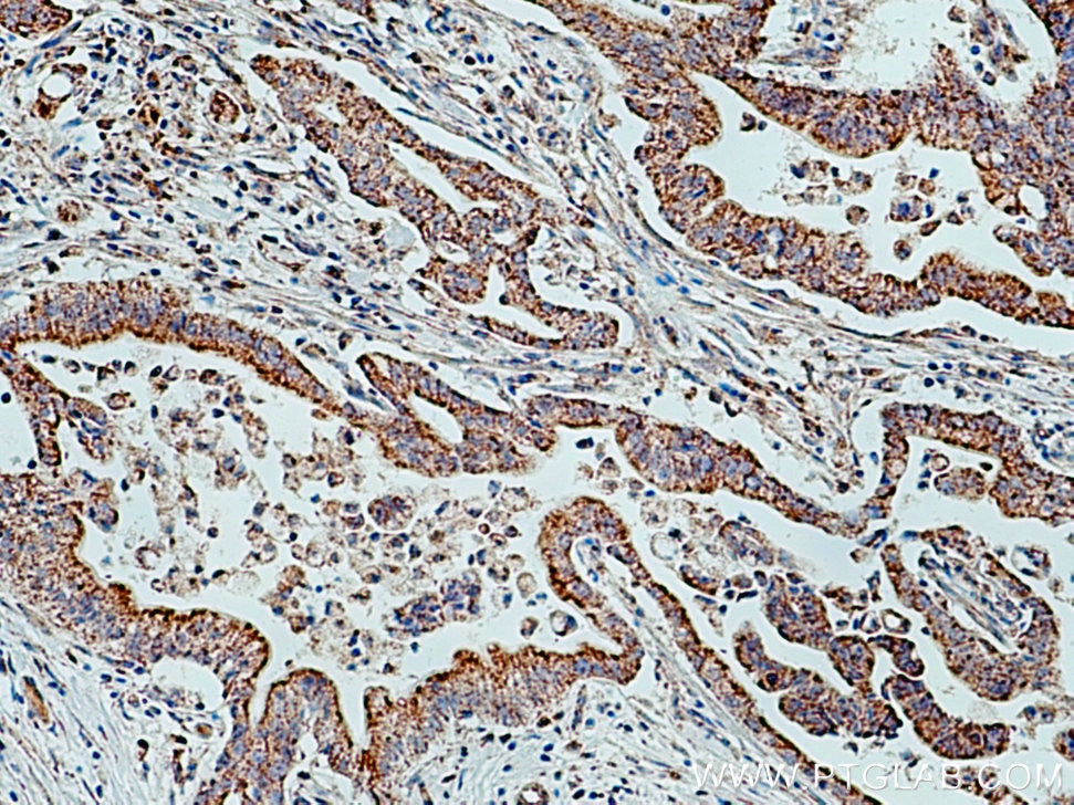 Immunohistochemistry (IHC) staining of human pancreas cancer tissue using EDIL3 Polyclonal antibody (12580-1-AP)