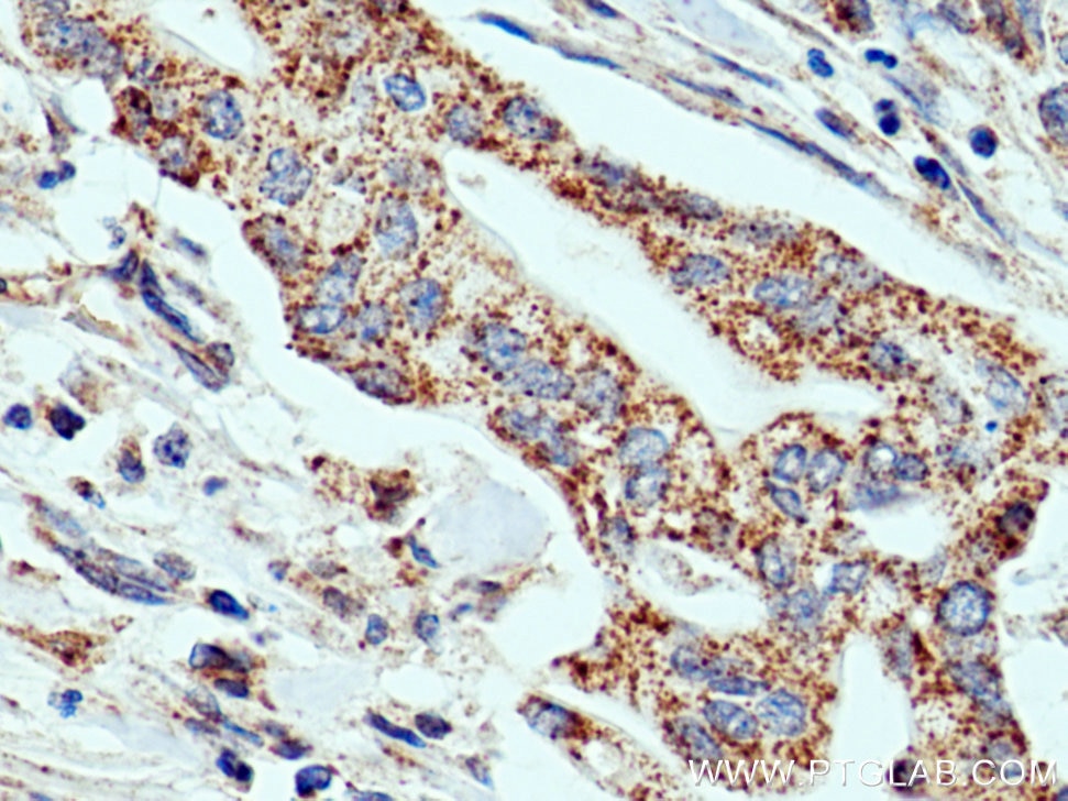IHC staining of human pancreas cancer using 12580-1-AP