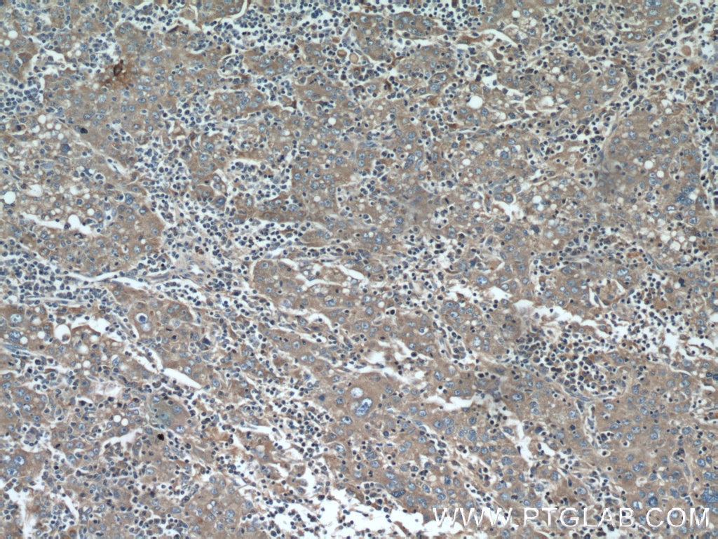 Immunohistochemistry (IHC) staining of human liver cancer tissue using EDIL3 Polyclonal antibody (12580-1-AP)