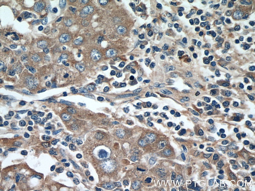 Immunohistochemistry (IHC) staining of human liver cancer tissue using EDIL3 Polyclonal antibody (12580-1-AP)