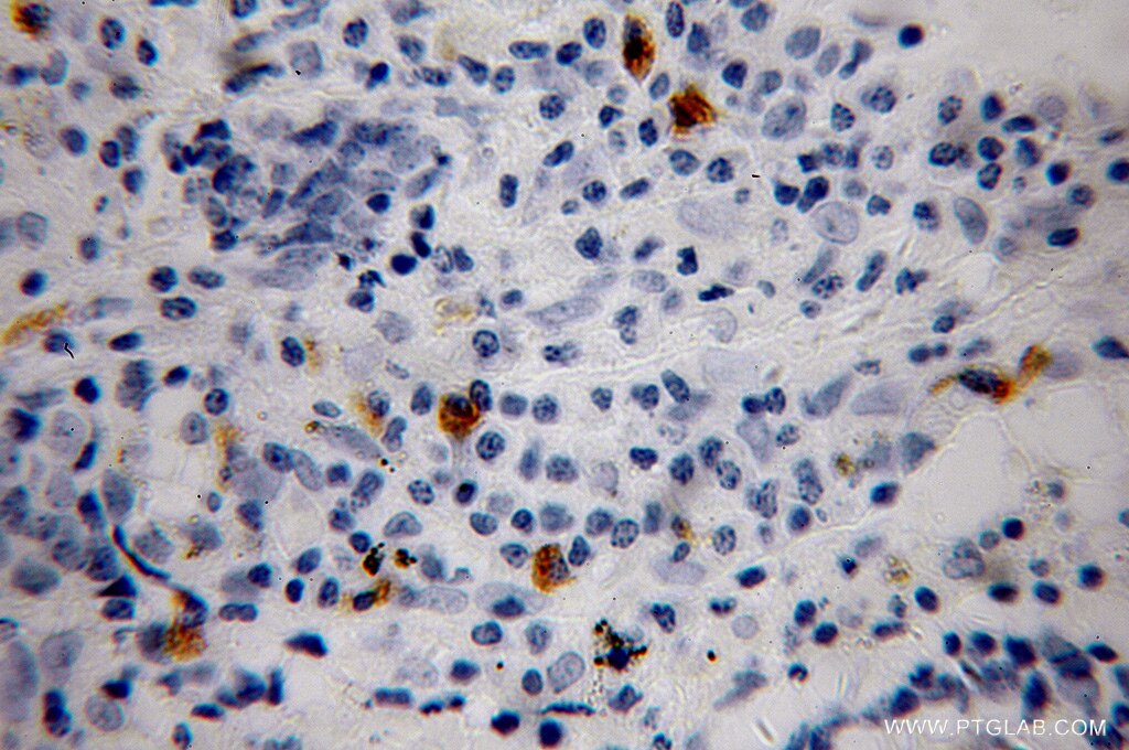 Immunohistochemistry (IHC) staining of human lung cancer tissue using EDN2 Polyclonal antibody (13272-1-AP)