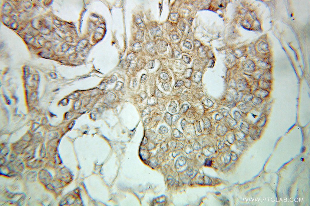 Immunohistochemistry (IHC) staining of human breast cancer tissue using Endothelin 3 Polyclonal antibody (10674-1-AP)