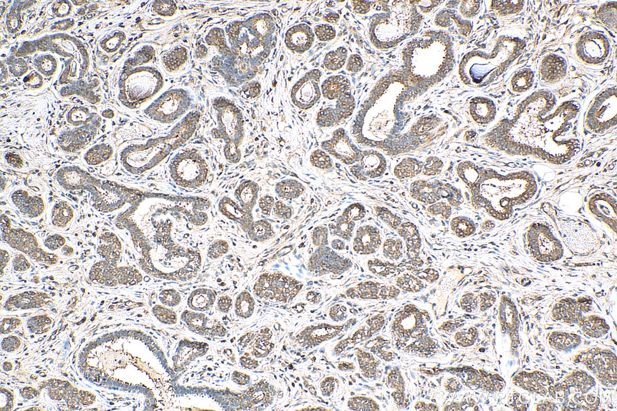 Immunohistochemistry (IHC) staining of human breast cancer tissue using EEA1 Polyclonal antibody (28347-1-AP)