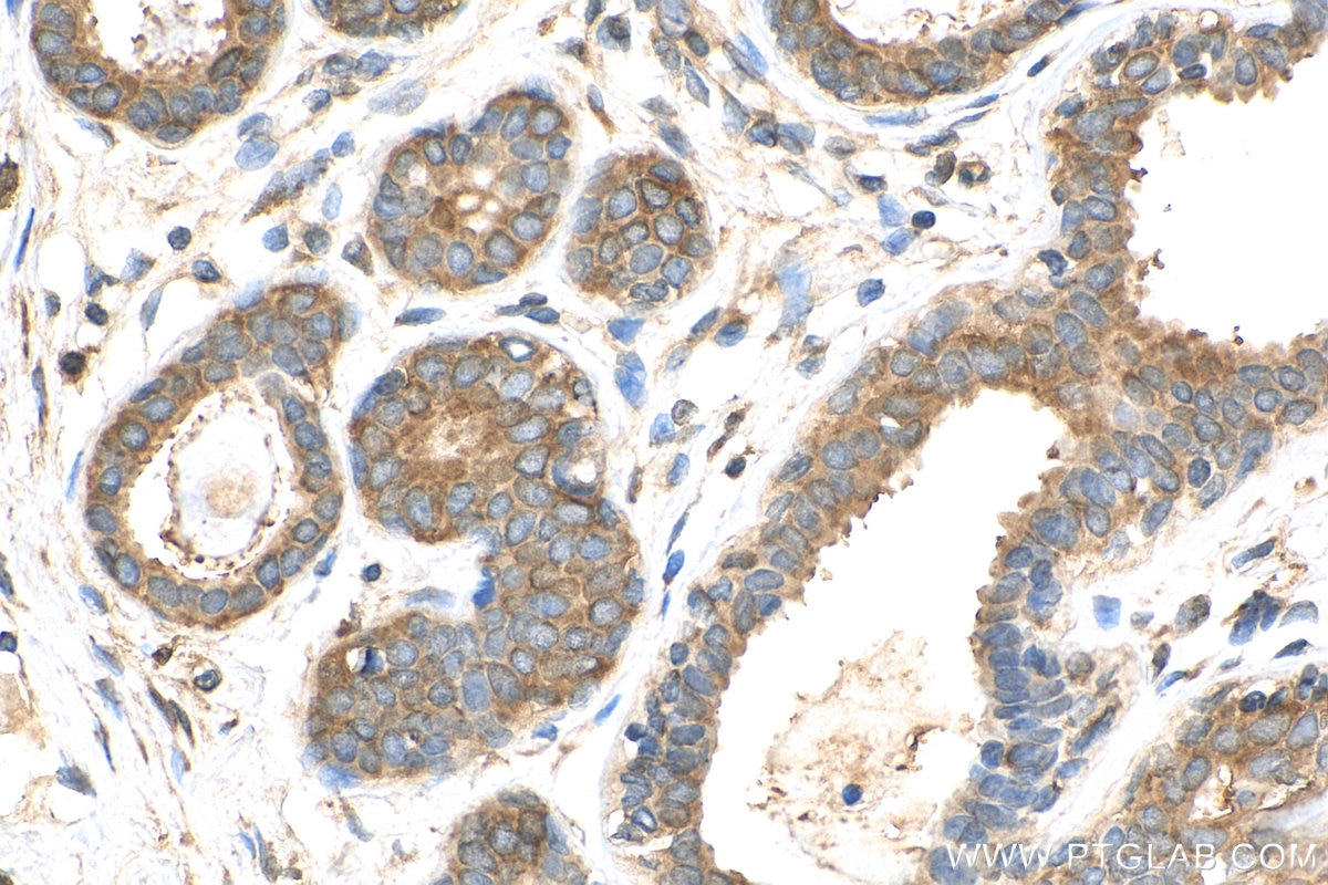 Immunohistochemistry (IHC) staining of human breast cancer tissue using EEA1 Polyclonal antibody (28347-1-AP)