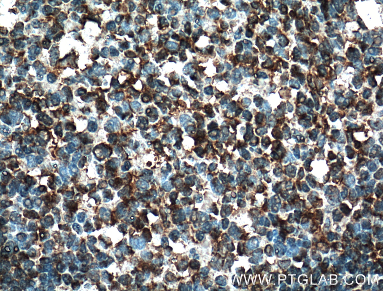 Immunohistochemistry (IHC) staining of human tonsillitis tissue using EED Polyclonal antibody (16818-1-AP)