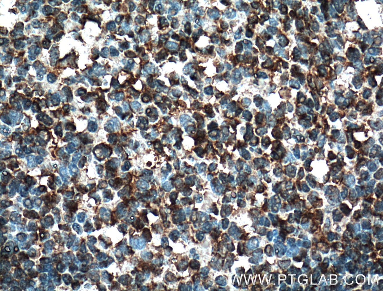 IHC staining of human tonsillitis using 16818-1-AP