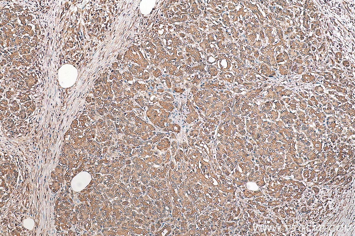 Immunohistochemistry (IHC) staining of human pancreas cancer tissue using EEF1A1 Polyclonal antibody (11402-1-AP)