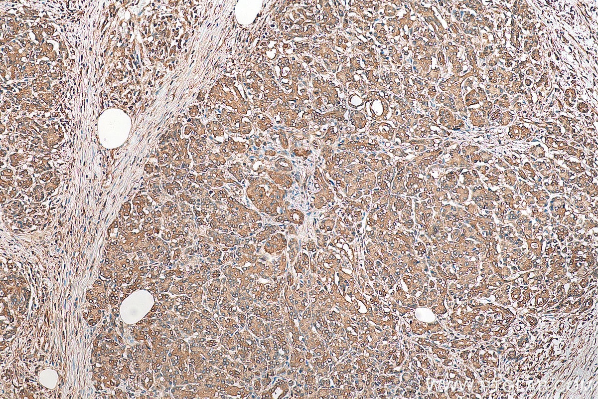 IHC staining of human pancreas cancer using 11402-1-AP