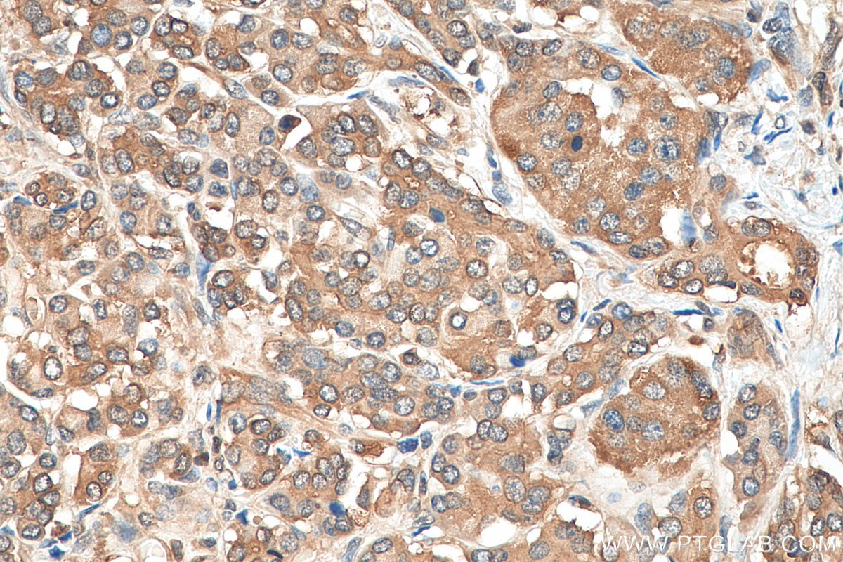 Immunohistochemistry (IHC) staining of human pancreas cancer tissue using EEF1A1 Polyclonal antibody (11402-1-AP)