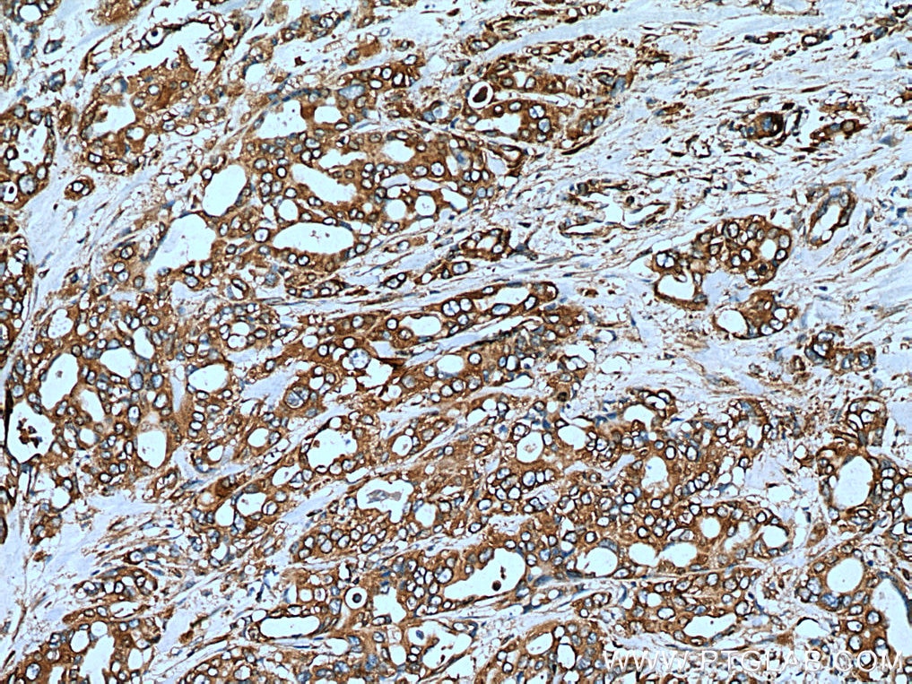 Immunohistochemistry (IHC) staining of human pancreas cancer tissue using EEF1A1 Monoclonal antibody (67495-1-Ig)
