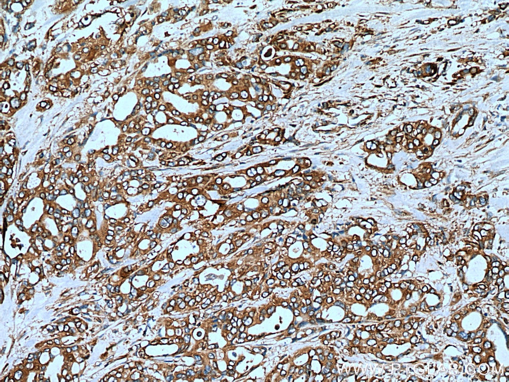 IHC staining of human pancreas cancer using 67495-1-Ig