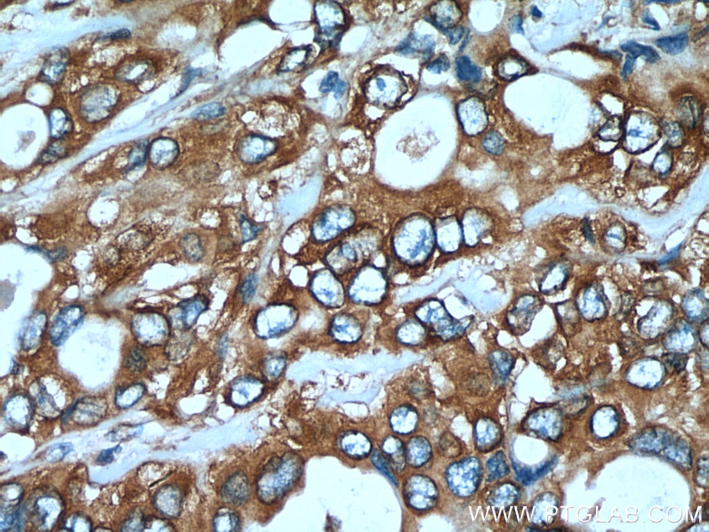 Immunohistochemistry (IHC) staining of human pancreas cancer tissue using EEF1A1 Monoclonal antibody (67495-1-Ig)