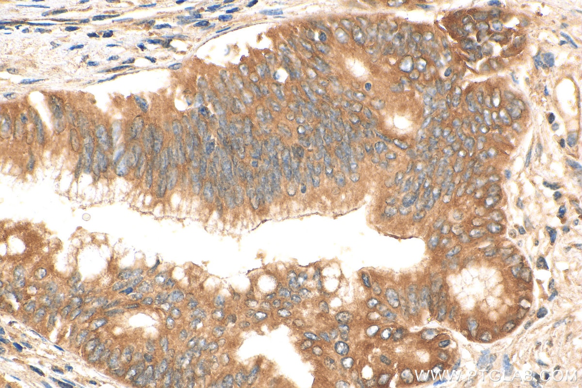 Immunohistochemistry (IHC) staining of human pancreas cancer tissue using EEF1A1 Recombinant antibody (81377-1-RR)