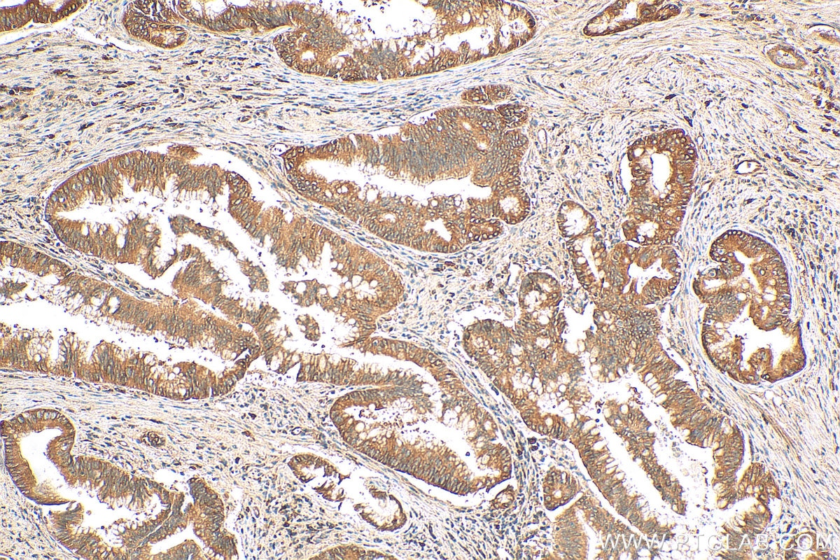 Immunohistochemistry (IHC) staining of human pancreas cancer tissue using EEF1A1 Recombinant antibody (81377-1-RR)