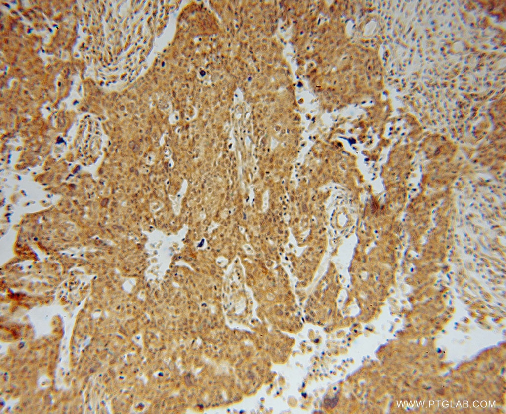 Immunohistochemistry (IHC) staining of human ovary tumor tissue using EEF1A2 Polyclonal antibody (16091-1-AP)