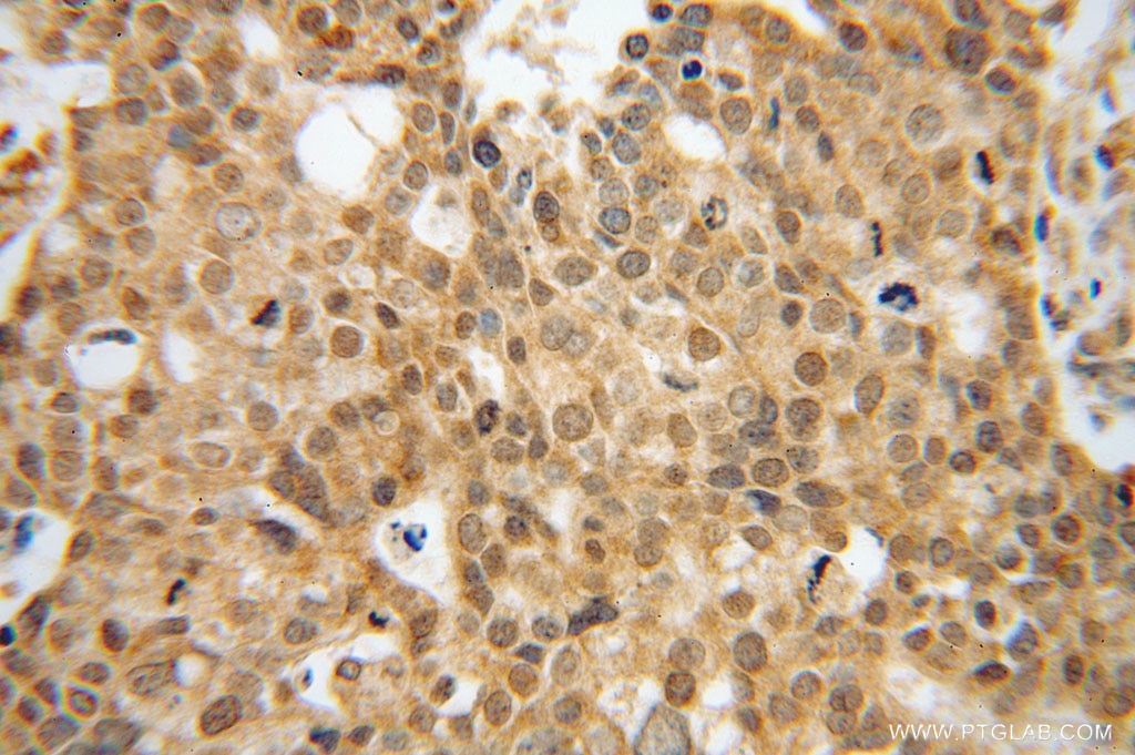 Immunohistochemistry (IHC) staining of human ovary tumor tissue using EEF1A2 Polyclonal antibody (16091-1-AP)