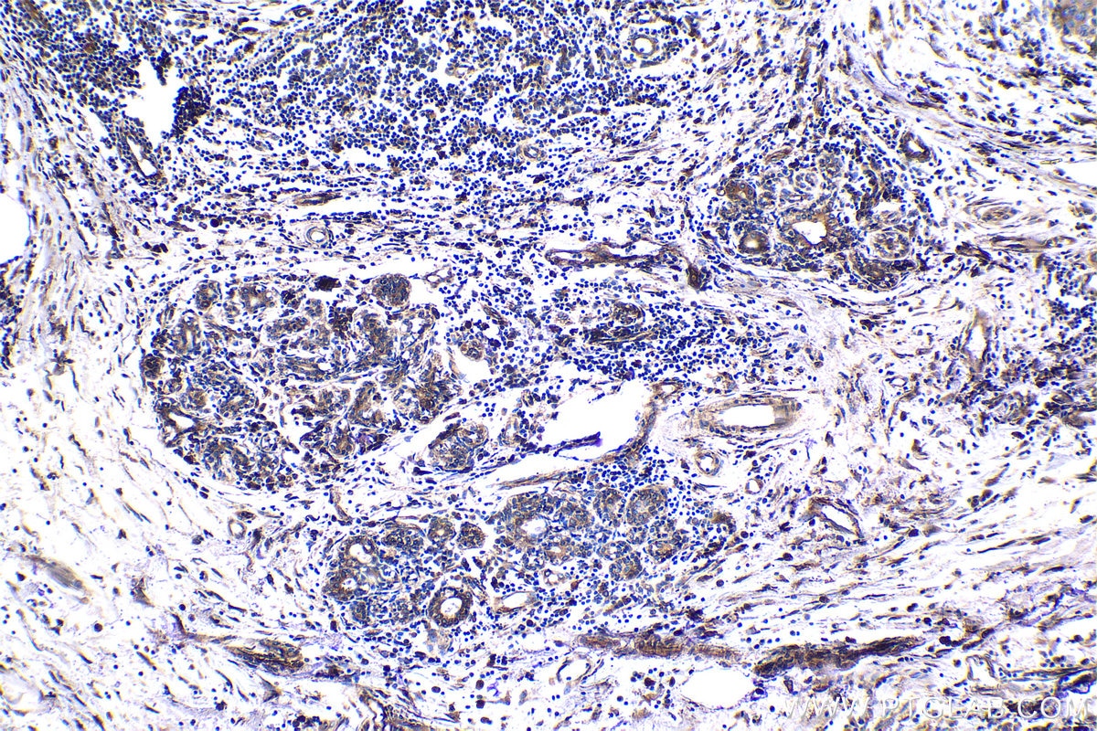Immunohistochemistry (IHC) staining of human breast cancer tissue using EEF1B2 Polyclonal antibody (10095-2-AP)