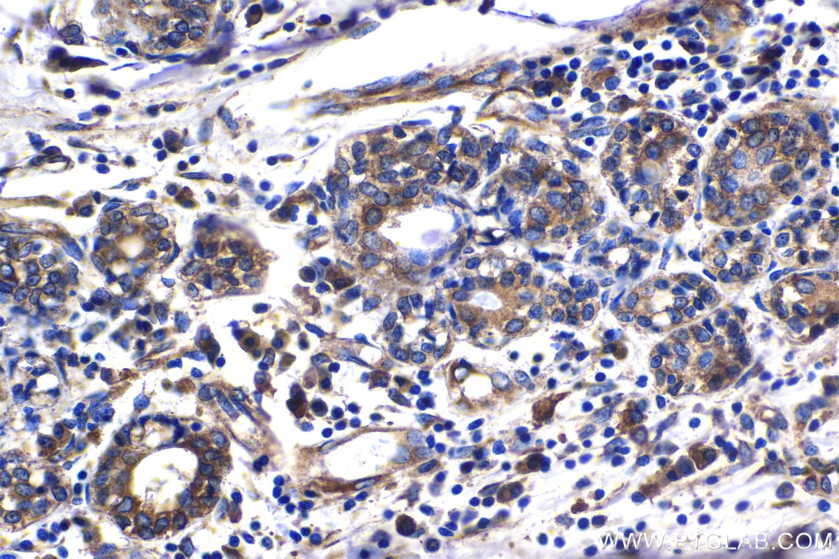 Immunohistochemistry (IHC) staining of human breast cancer tissue using EEF1B2 Polyclonal antibody (10095-2-AP)