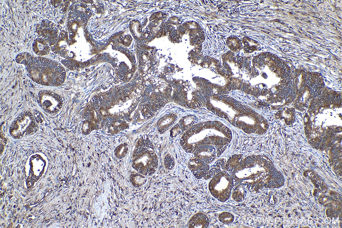 IHC staining of human pancreas cancer using 10095-2-AP