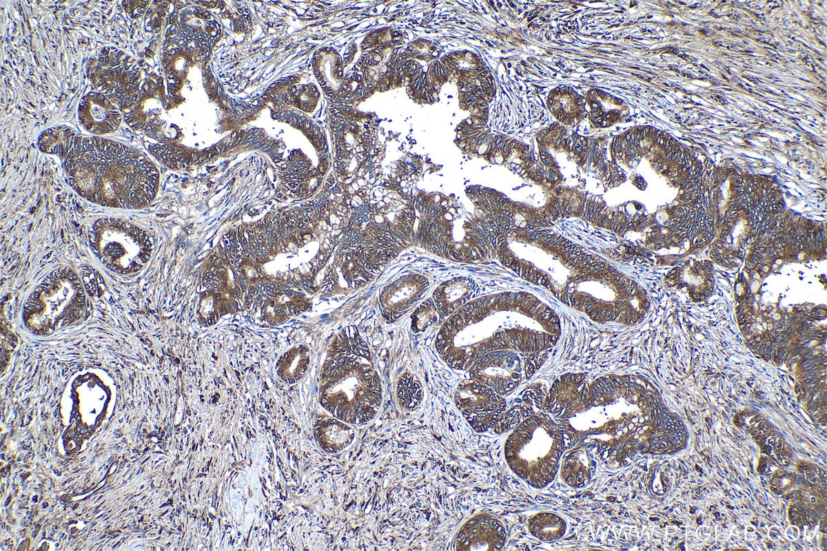 Immunohistochemistry (IHC) staining of human pancreas cancer tissue using EEF1B2 Polyclonal antibody (10095-2-AP)