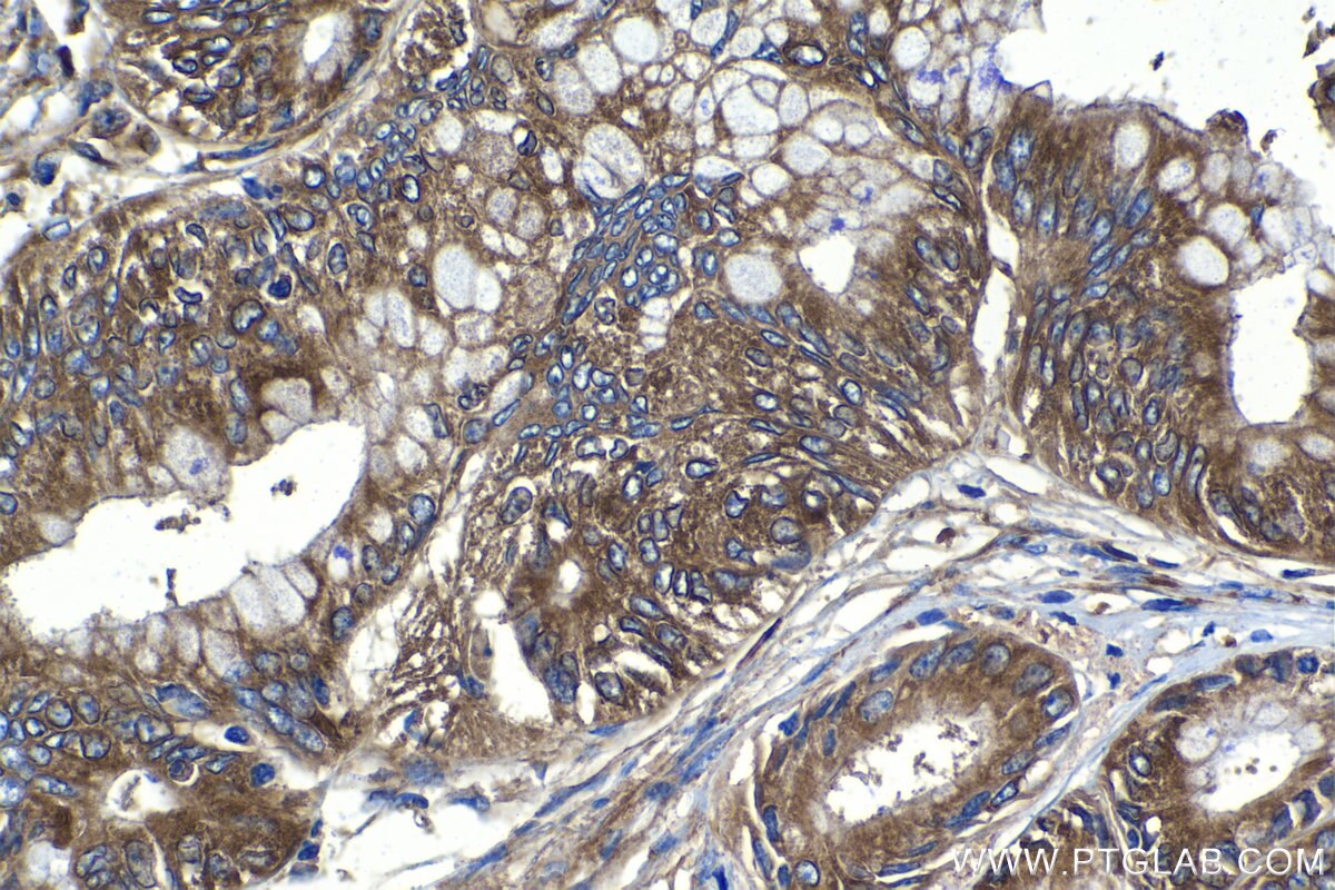 IHC staining of human pancreas cancer using 10095-2-AP