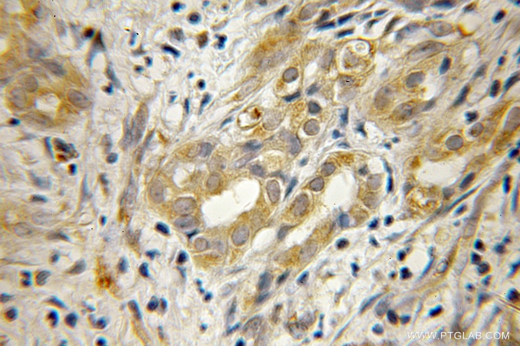 Immunohistochemistry (IHC) staining of human pancreas cancer tissue using EEF1B2 Polyclonal antibody (10095-2-AP)