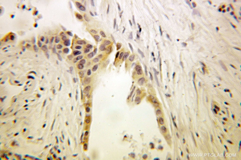 Immunohistochemistry (IHC) staining of human pancreas cancer tissue using EEF1B2 Polyclonal antibody (10483-1-AP)