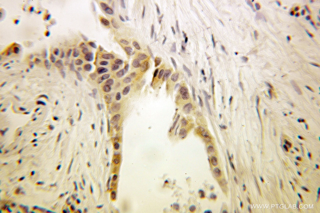 IHC staining of human pancreas cancer using 10483-1-AP