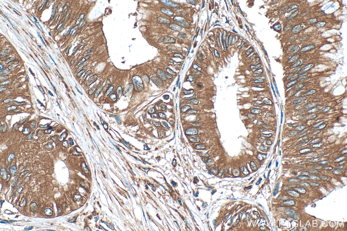 Immunohistochemistry (IHC) staining of human pancreas cancer tissue using EEF1D Polyclonal antibody (10630-1-AP)