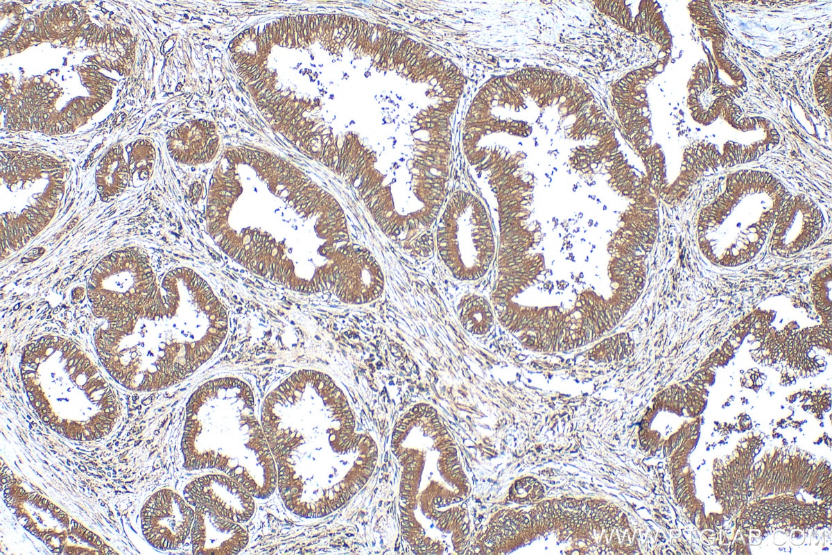 Immunohistochemistry (IHC) staining of human pancreas cancer tissue using EEF1D Polyclonal antibody (10630-1-AP)