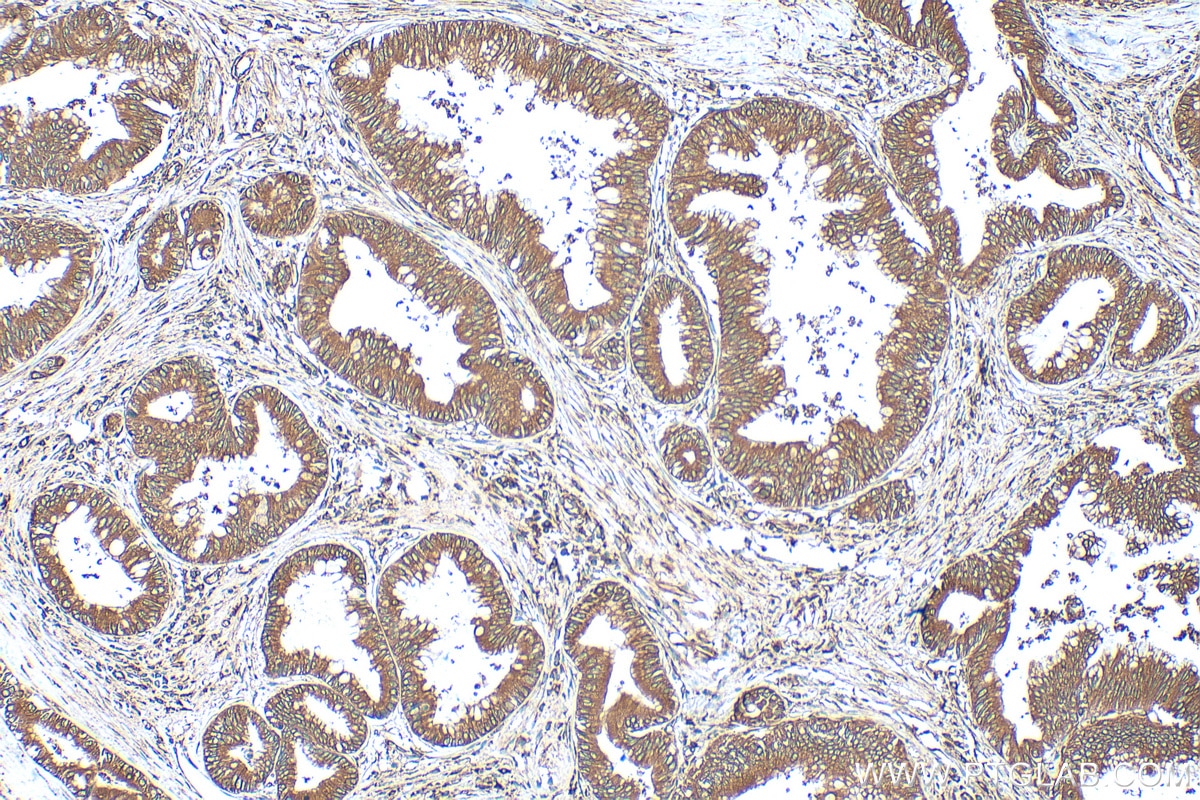 IHC staining of human pancreas cancer using 10630-1-AP