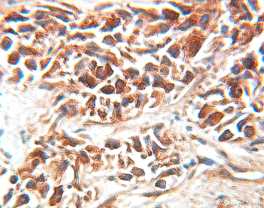 Immunohistochemistry (IHC) staining of human prostate cancer tissue using EEF1D Polyclonal antibody (10630-1-AP)