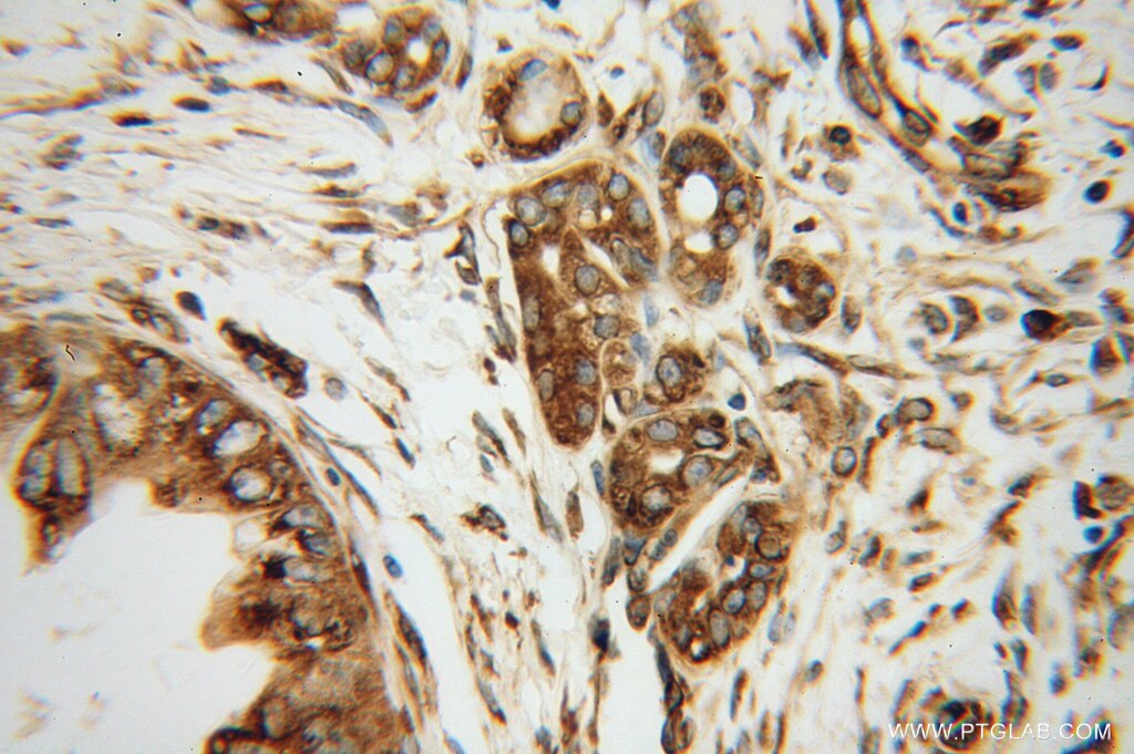 Immunohistochemistry (IHC) staining of human pancreas cancer tissue using EEF1D Polyclonal antibody (10630-1-AP)