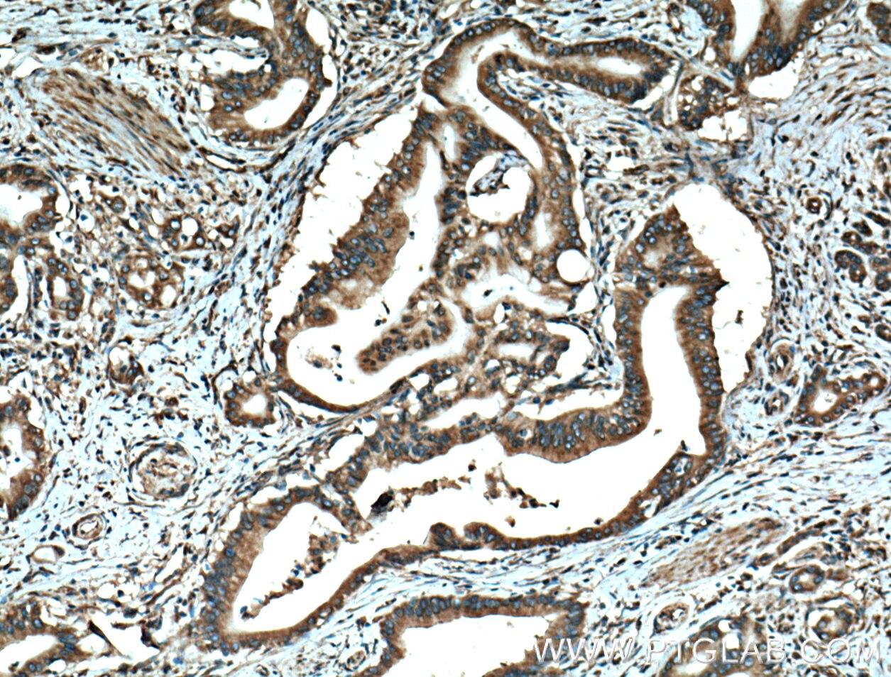 Immunohistochemistry (IHC) staining of human pancreas cancer tissue using EEF1D Monoclonal antibody (60085-1-Ig)