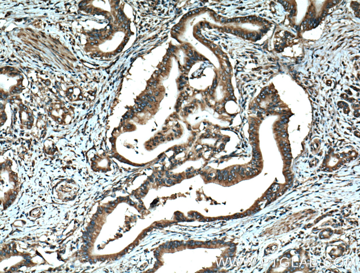 IHC staining of human pancreas cancer using 60085-1-Ig