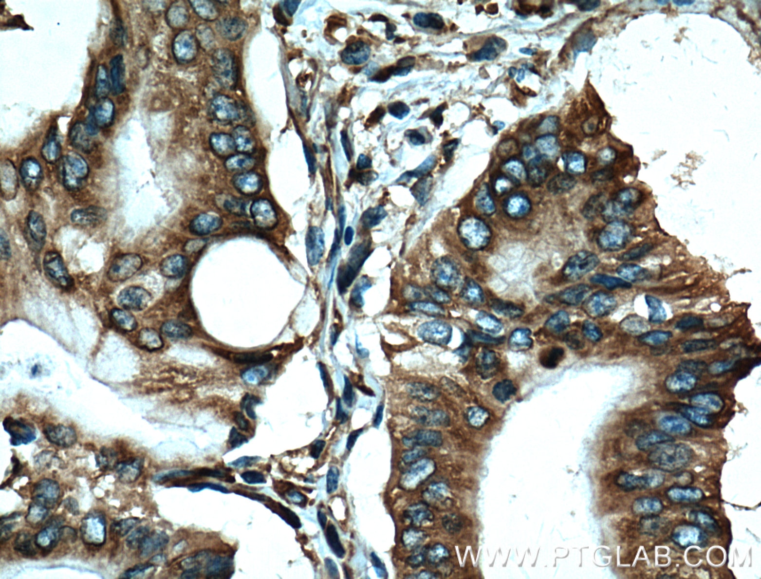 Immunohistochemistry (IHC) staining of human pancreas cancer tissue using EEF1D Monoclonal antibody (60085-1-Ig)