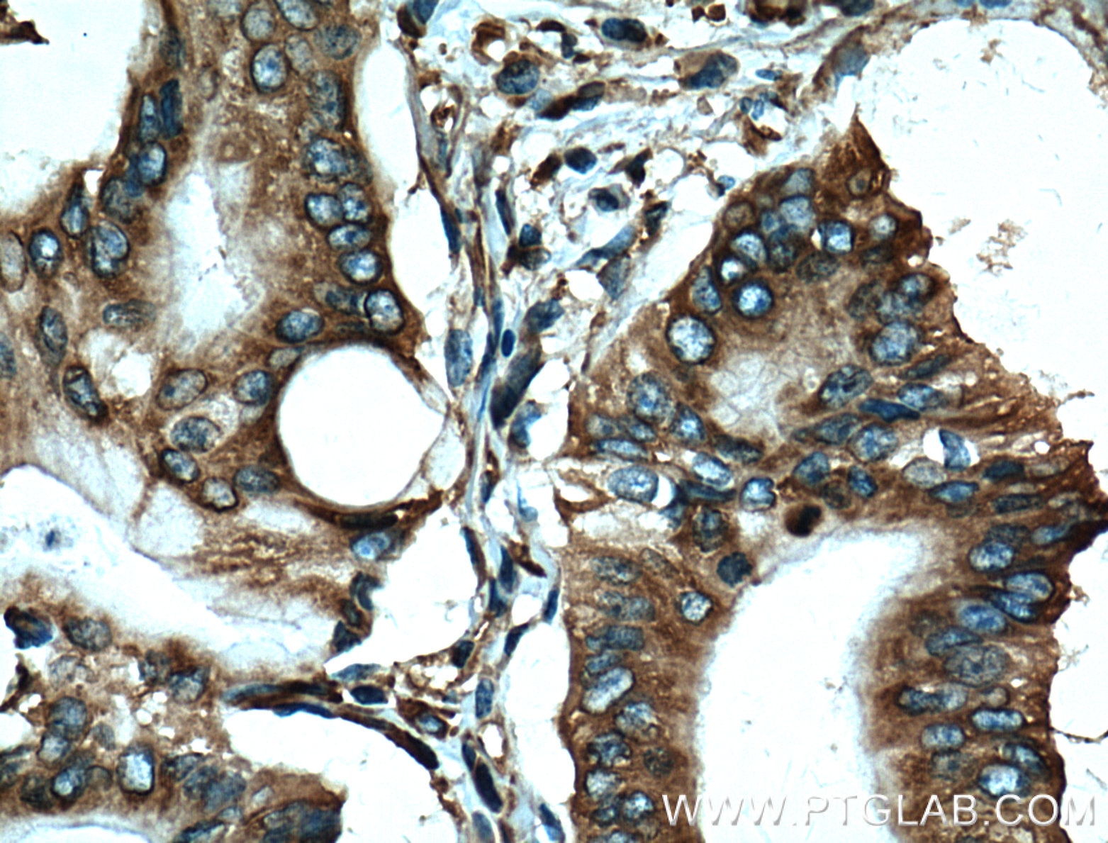 IHC staining of human pancreas cancer using 60085-1-Ig