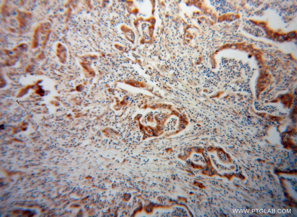 Immunohistochemistry (IHC) staining of human pancreas cancer tissue using EEF1D Monoclonal antibody (60085-1-Ig)