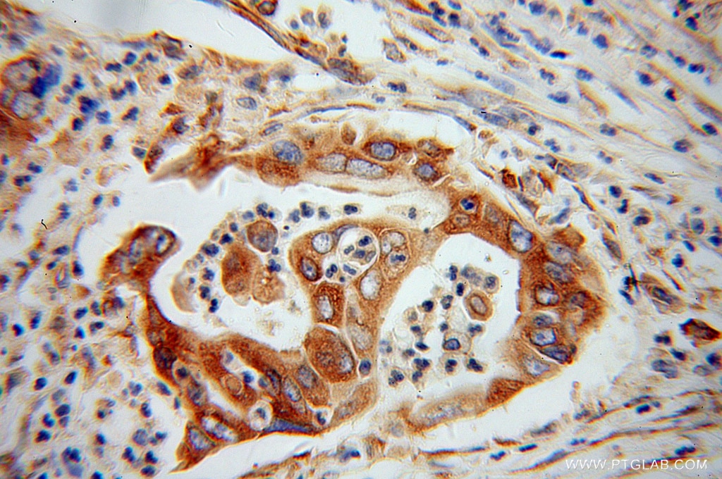 Immunohistochemistry (IHC) staining of human pancreas cancer tissue using EEF1D Monoclonal antibody (60085-1-Ig)