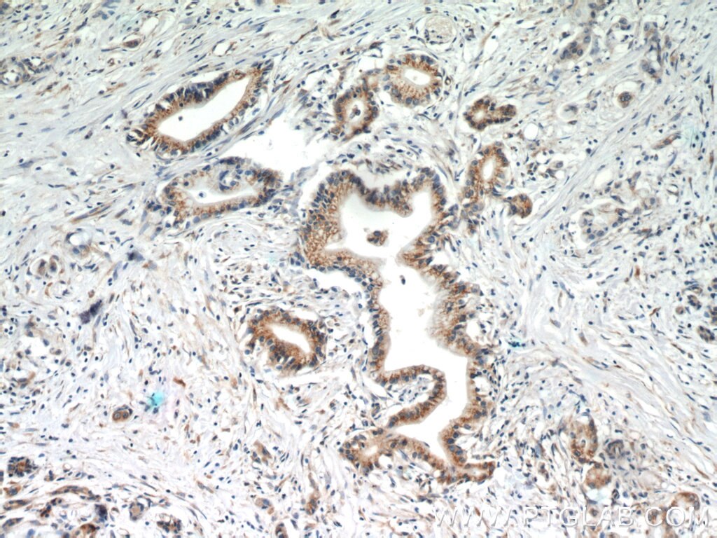 IHC staining of human pancreas cancer using 60085-2-Ig