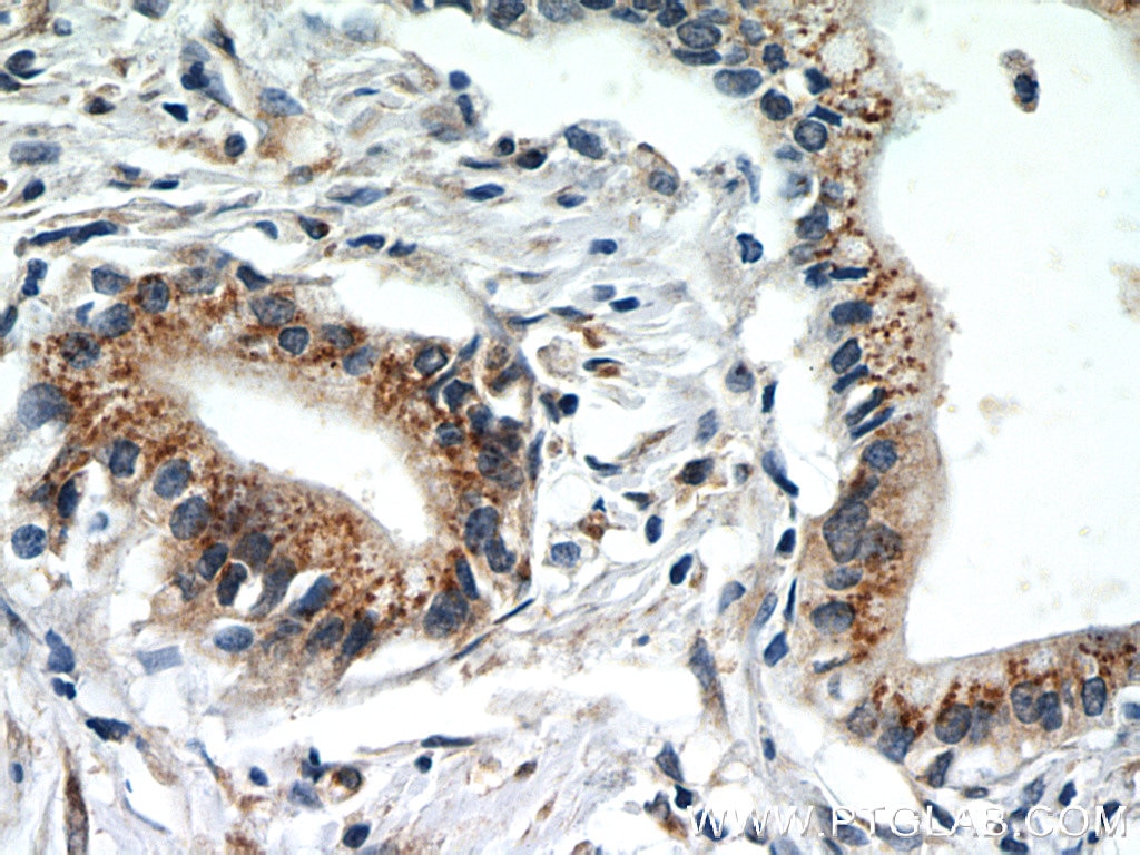 Immunohistochemistry (IHC) staining of human pancreas cancer tissue using EEF1D Monoclonal antibody (60085-2-Ig)