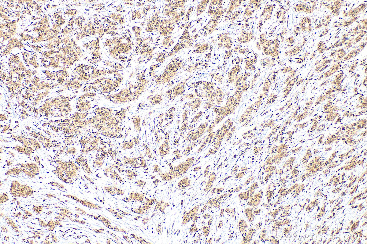 Immunohistochemistry (IHC) staining of human breast cancer tissue using EEF1E1 Polyclonal antibody (10805-1-AP)