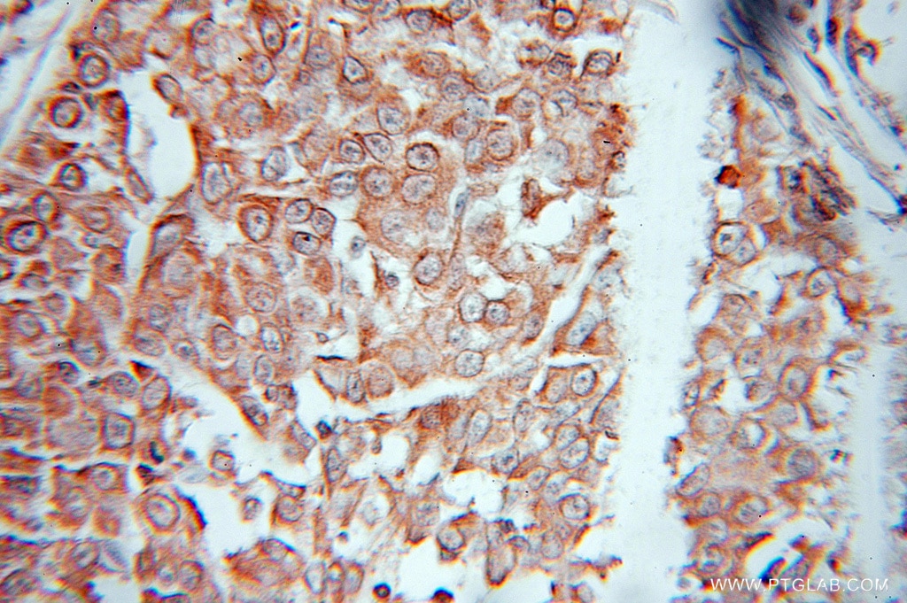 Immunohistochemistry (IHC) staining of human breast cancer tissue using EEF1E1 Polyclonal antibody (10805-1-AP)