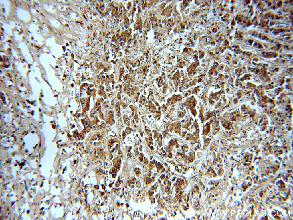 Immunohistochemistry (IHC) staining of human breast cancer tissue using EEF2 Polyclonal antibody (20107-1-AP)
