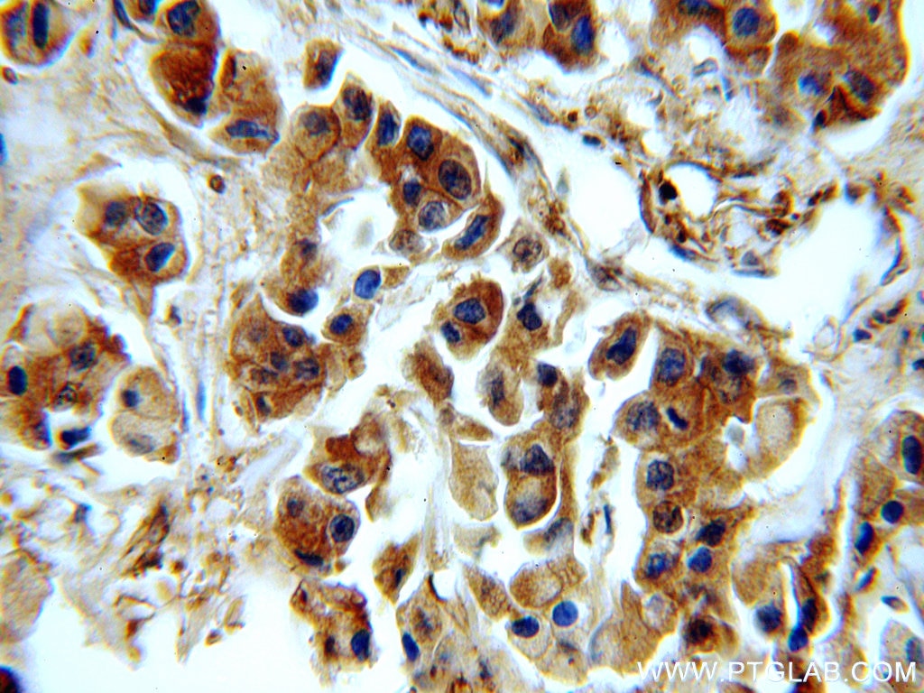 Immunohistochemistry (IHC) staining of human breast cancer tissue using EEF2 Polyclonal antibody (20107-1-AP)