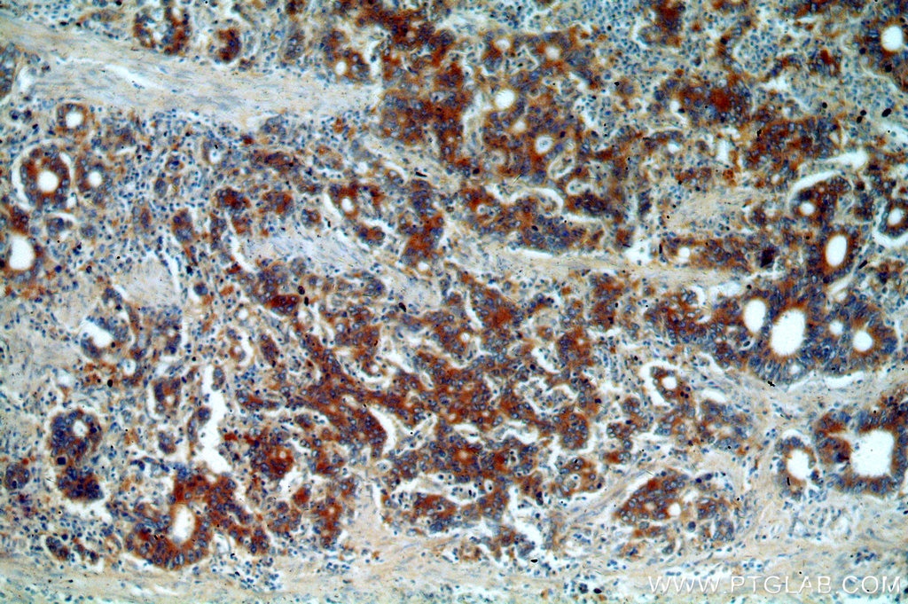 Immunohistochemistry (IHC) staining of human stomach cancer tissue using EEF2 Polyclonal antibody (20107-1-AP)